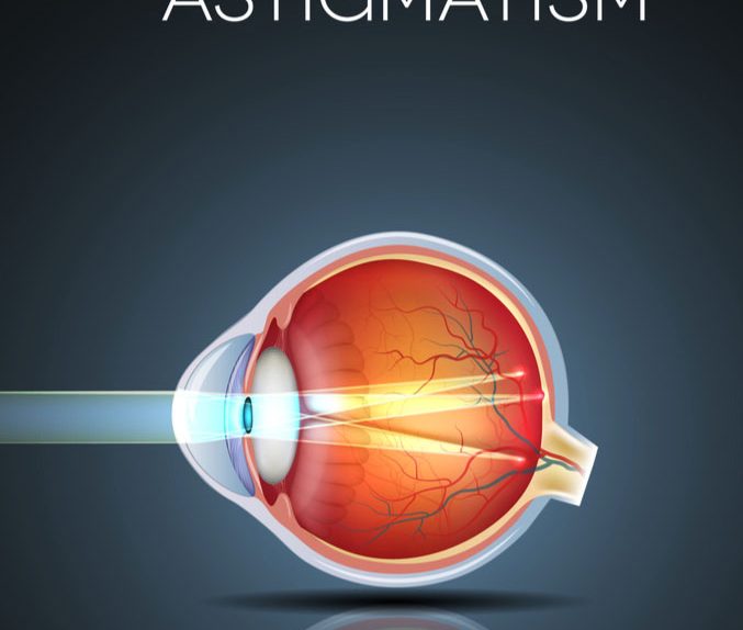 O QUE É astigmatismo? – Usee ótica